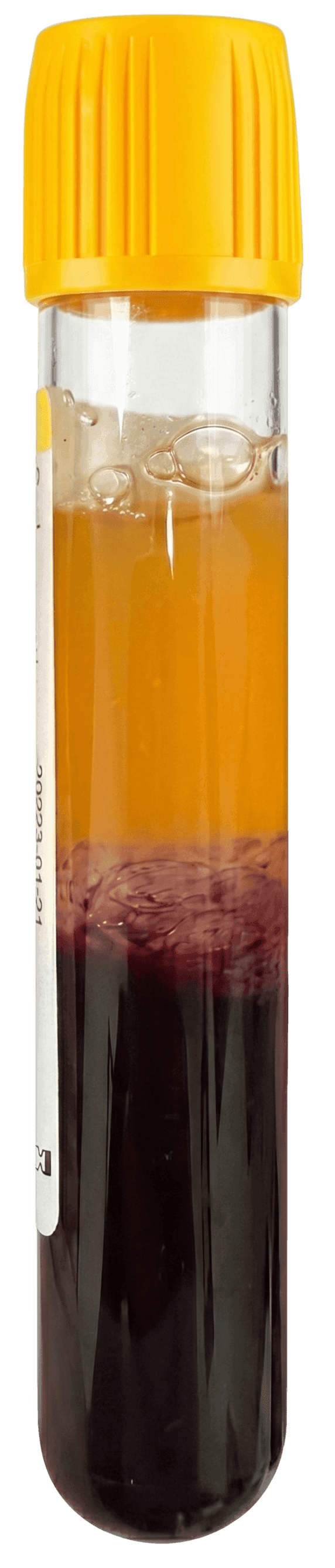 Selphyl PRP tube showing separated blood layers