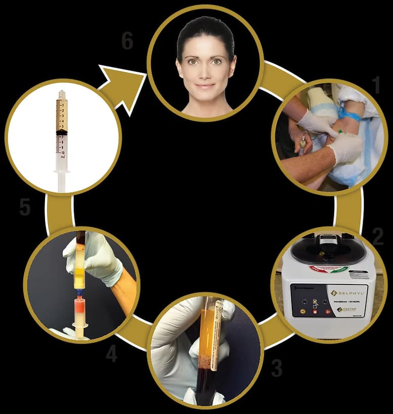 Selphyl PRP 6-Step Process Diagram